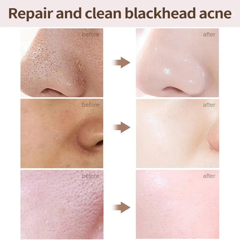 Salicylic Acid Pore Minimizing Cream – Blackhead Remover & Oil Control Face Cream