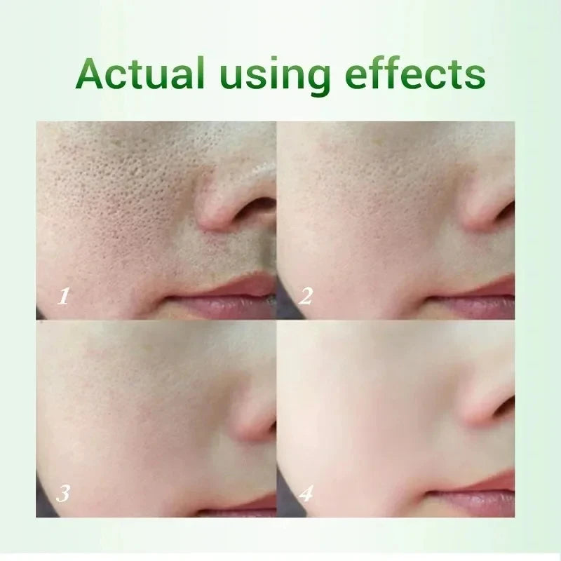 Salicylic Acid Pore Minimizing Cream – Blackhead Remover & Oil Control Face Cream
